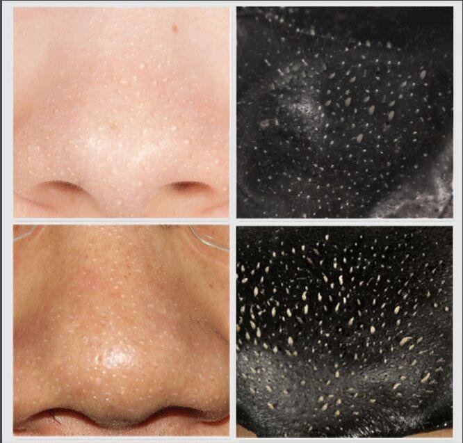 Как выглядят поры на коже Черная маска Black Head ex pore(6грамм) - купить в Иваново, цена 50 руб., продан