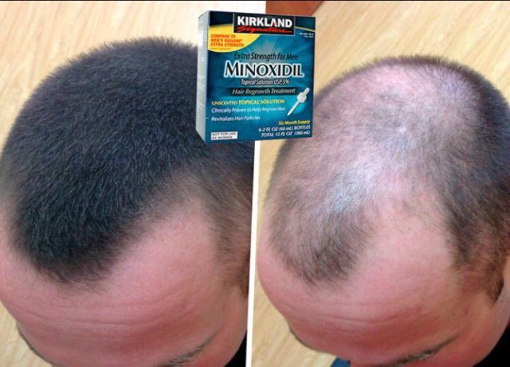 Миноксидил форум. Миноксидил 3 в 1. Средство от выпадения волос у мужчин миноксидил. Миноксидил для волос для мужчин для бороды 5%. Minoxidil Kirkland 5 для бороды.