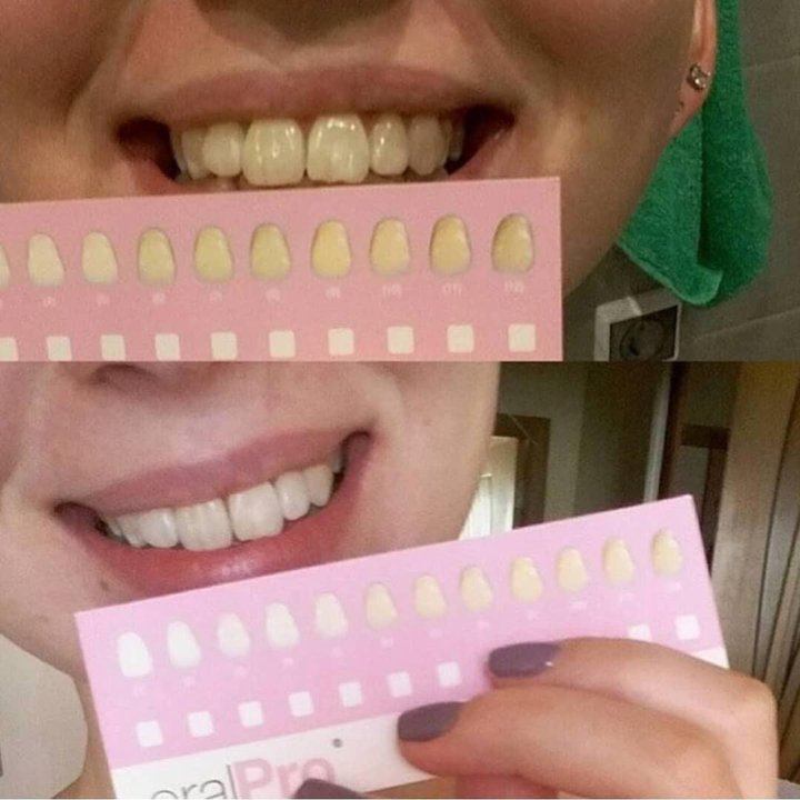 Отбеливание зубов oral pro отзывы фиксики серия щетка зубная