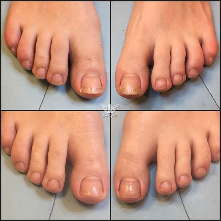 Педикюр с грибком ногтей. Грибок ногтей на ногах до и после. Педикюр грибковых ногтей. Ногти до и после педикюра.