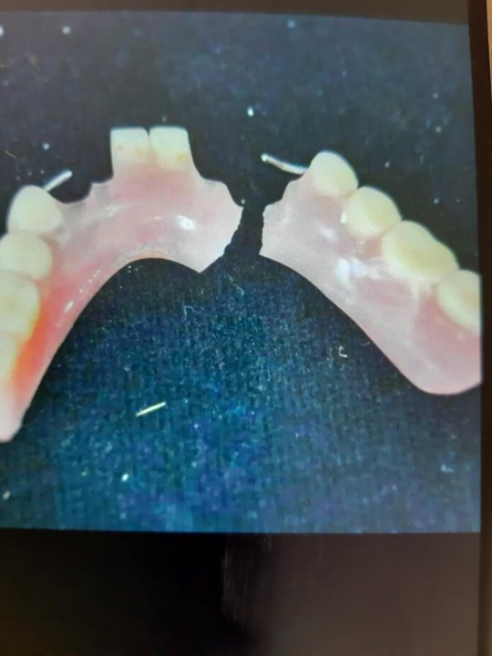 Починка съемного протеза. Клей для пластмассовых протезов. Починка семеого протез а. Починка линейного перелома базиса съемного пластиночного протеза. Протезу можно приклеить зуб.