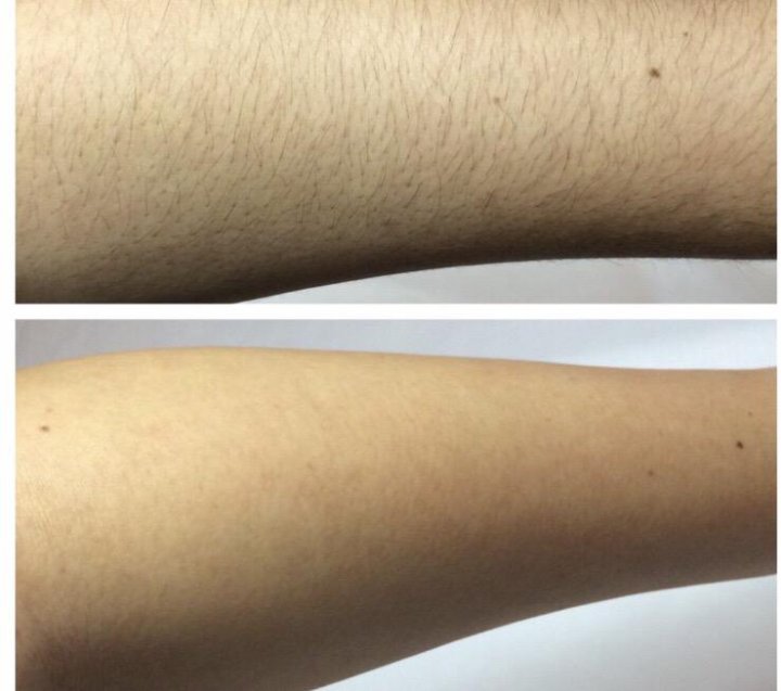 Депиляция рук. Волосы на руках и ногах. Депиляция рук. Депиляция рук до после. Шугаринг рук.