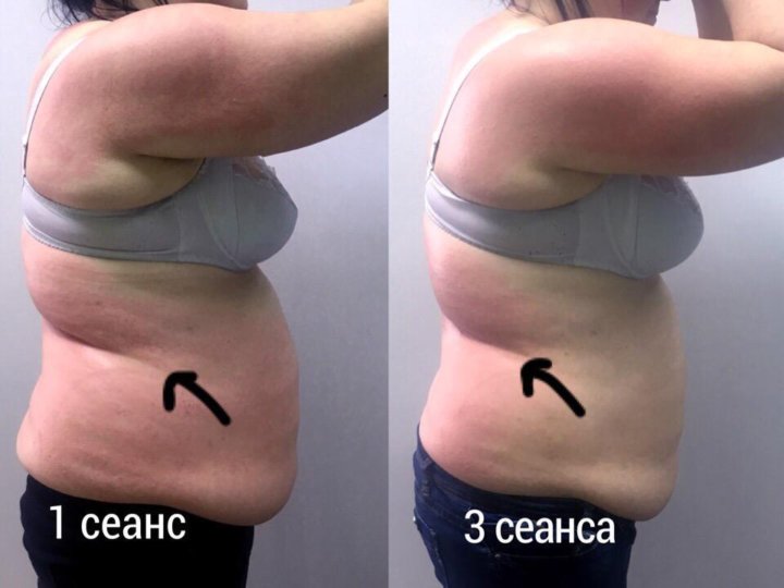 Тейпирование при беременности. Тейпирование бедер для похудения. Тейпирование для похудения живота и боков. Тейпирование диастаза. Тейпирование диастаза.