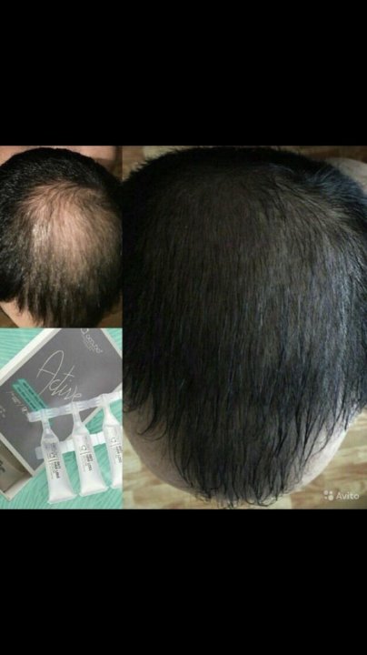 Occuba active сыворотка против выпадения волос как пользоваться