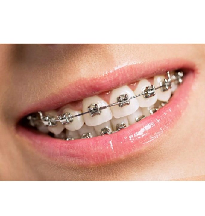брекеты керамические и металлические. сколько стоят брекеты для детей 10 лет в россии. можно поставить брекеты по омс. можно поставить брекеты по омс. можно поставить брекеты по омс.