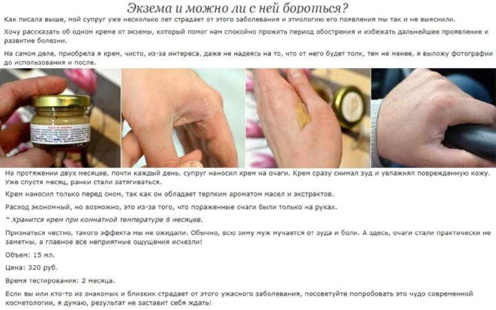 Экзема на руках мазь для лечения фото