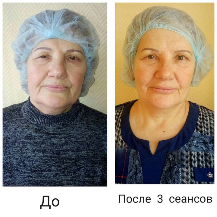 Буккальный массаж до и после. Буккальный массаж лица до и после. Буккальный массаж лица фото до и после. Буккальный массаж лица отзывы с фото до и после.