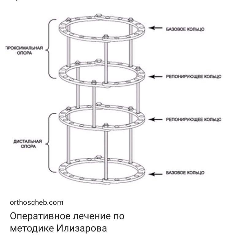 Аппарат илизарова рисунок